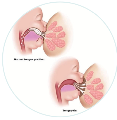 Frenectomies can help breastfeeding